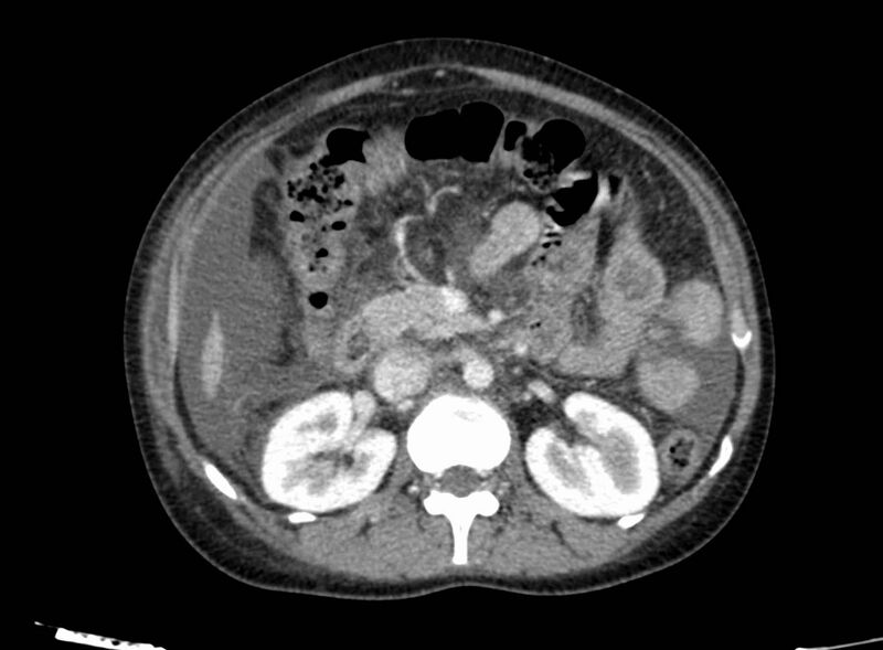 File:Acute Budd-Chiari syndrome (Radiopaedia 60858-68638 Axial C+ portal venous phase 124).jpg
