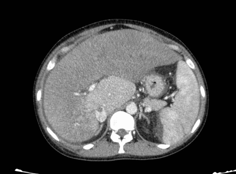 File:Acute Budd-Chiari syndrome (Radiopaedia 60858-68638 Axial C+ portal venous phase 88).jpg