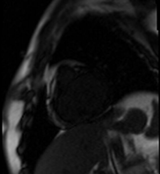 File:Acute anteroseptal myocardial infarction (Radiopaedia 68409-77945 Short axis (basal) Perfusion 1).jpg