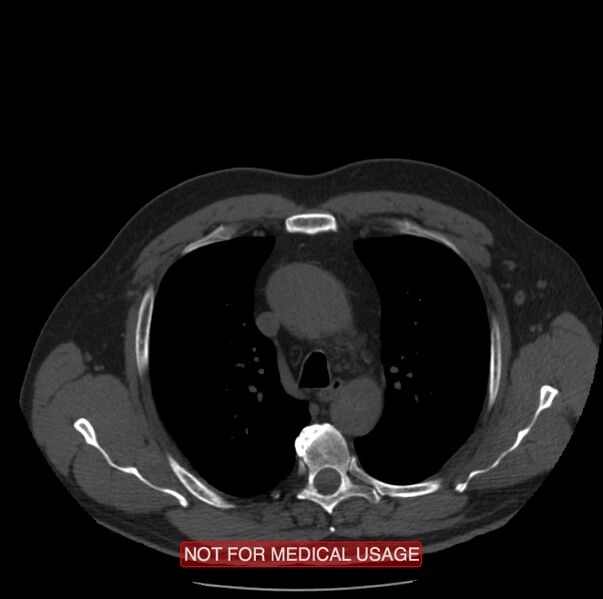 File:Acute aortic dissection - Stanford type A (Radiopaedia 40661-43285 Axial non-contrast 10).jpg