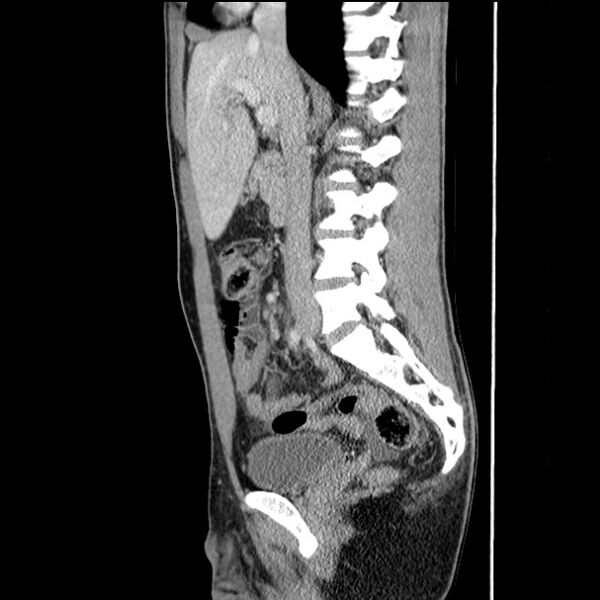 File:Acute appendicitis (Radiopaedia 27049-27227 Sagittal C+ portal venous phase 35).jpg