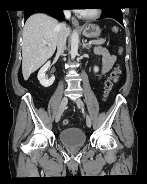File:Acute appendicitis - large appendicoliths (Radiopaedia 61805-69820 Coronal C+ portal venous phase 73).jpg