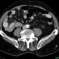 Acute appendicitis arising from a malrotated cecum (Radiopaedia 19970-19997 Axial C+ portal venous phase 24).jpg