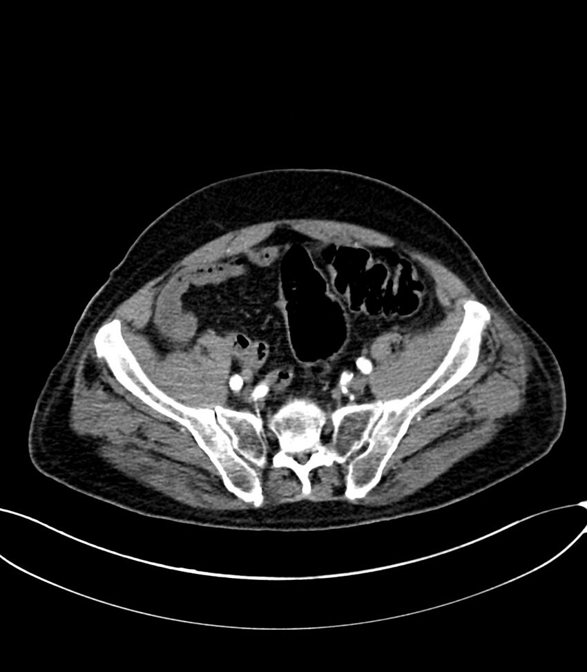 Acute arterial mesenteric ischemia (Radiopaedia 78238-90828 Axial C+ arterial phase 111).jpg