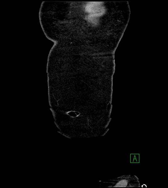File:Acute arterial mesenteric ischemia (Radiopaedia 78238-90828 Coronal C+ portal venous phase 10).jpg
