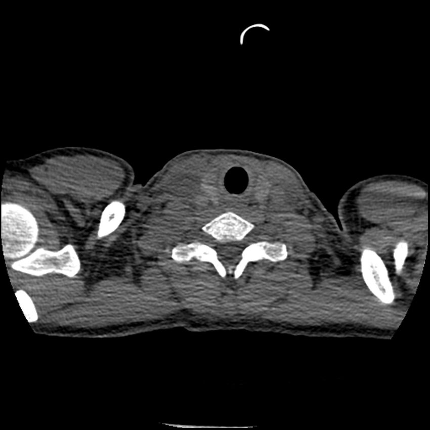 Acute chest syndrome - sickle cell disease (Radiopaedia 42375-45499 Axial C+ CTPA 2).jpg
