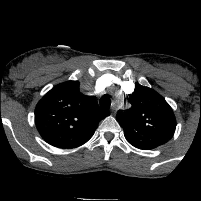 Acute chest syndrome - sickle cell disease (Radiopaedia 42375-45499 Axial C+ CTPA 43).jpg