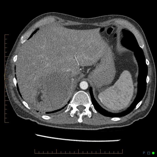 File:Acute hemorrhage into adrenal metastasis from NSCLC (Radiopaedia 43135-46429 Axial C+ arterial phase 5).jpg
