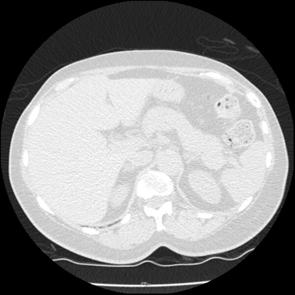 File:Acute interstitial pneumonitis (Radiopaedia 45404-49444 Axial lung window 100).jpg