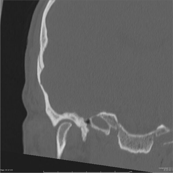 File:Acute otomastoiditis (Radiopaedia 28276-28512 Coronal PTB bone window reformat 14).jpg