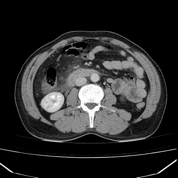 File:Acute pancreatitis (Radiopaedia 22572-22596 Axial C+ portal venous phase 37).jpg