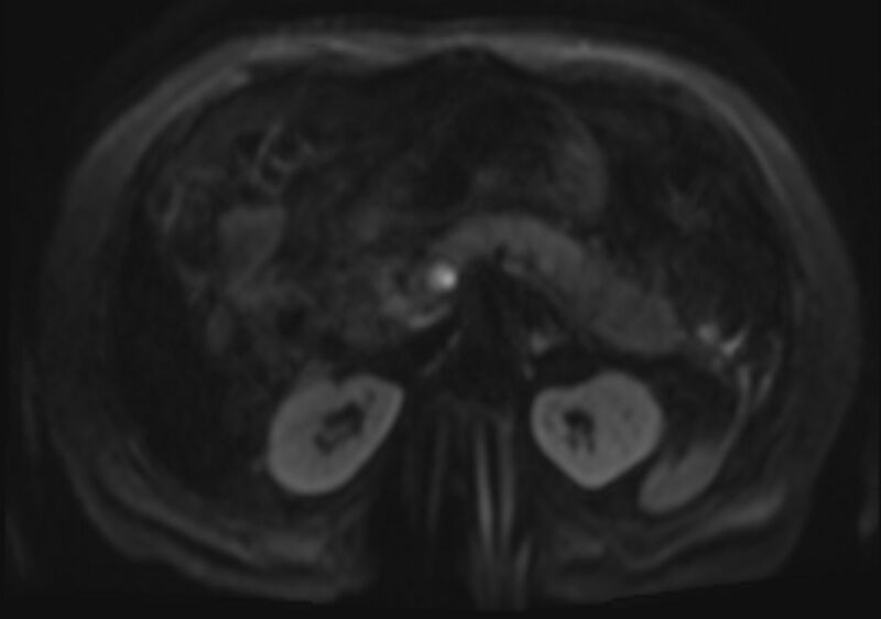 File:Acute portal vein thrombosis (Radiopaedia 73198-83925 Axial DWI 47).jpg