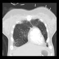 Acute pulmonary edema on CT (Radiopaedia 33582-34672 Coronal lung window 5).jpg