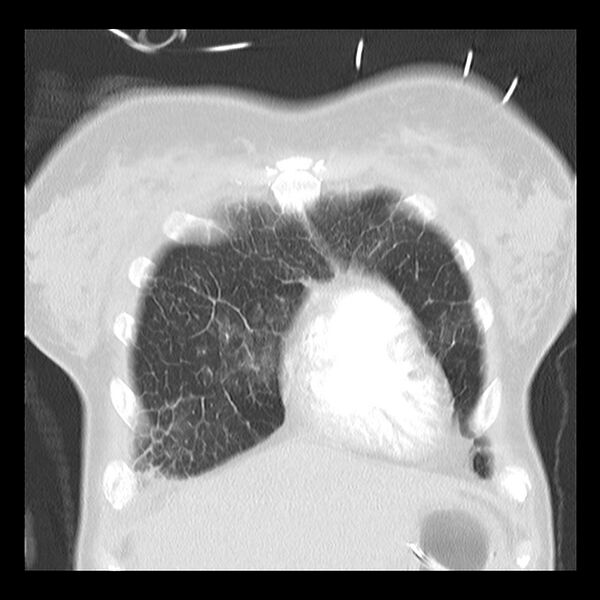 File:Acute pulmonary edema on CT (Radiopaedia 33582-34672 Coronal lung window 5).jpg