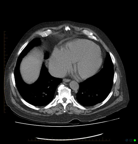 File:Acute renal failure post IV contrast injection- CT findings (Radiopaedia 47815-52557 Axial non-contrast 7).jpg
