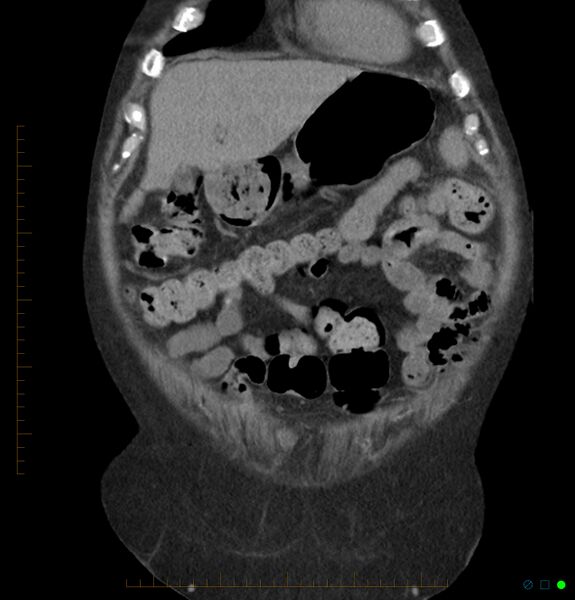 File:Acute renal failure post IV contrast injection- CT findings (Radiopaedia 47815-52557 Coronal non-contrast 7).jpg
