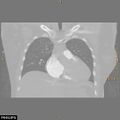 Acute reversible pulmonary hypertension and right heart failure from cocaine toxicity (Radiopaedia 49394-54517 Coronal C+ CTPA 14).jpg