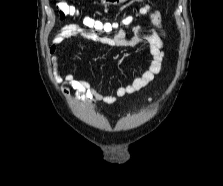 File:Acute sigmoid colon diverticulitis (Radiopaedia 55507-61976 Coronal C+ portal venous phase 5).jpg