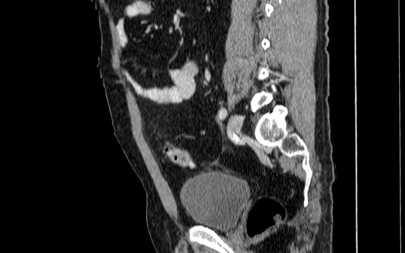 File:Acute sigmoid colon diverticulitis (Radiopaedia 55507-61976 Sagittal C+ portal venous phase 29).jpg