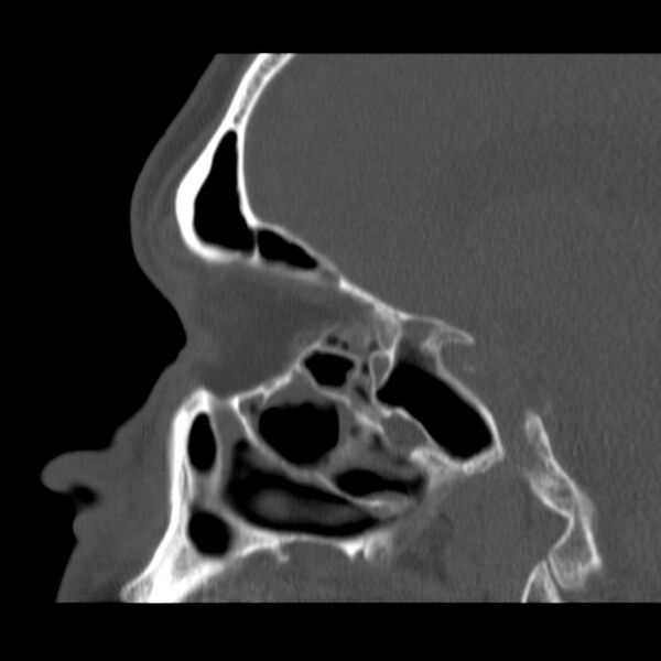 File:Acute sinusitis (Radiopaedia 23161-23215 Sagittal bone window 40).jpg