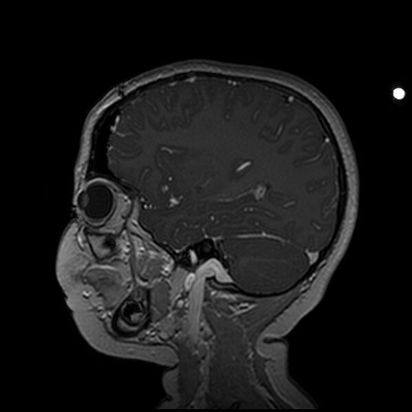 File:Adamantinomatous craniopharyngioma (Radiopaedia 77407-89529 H 37).jpg