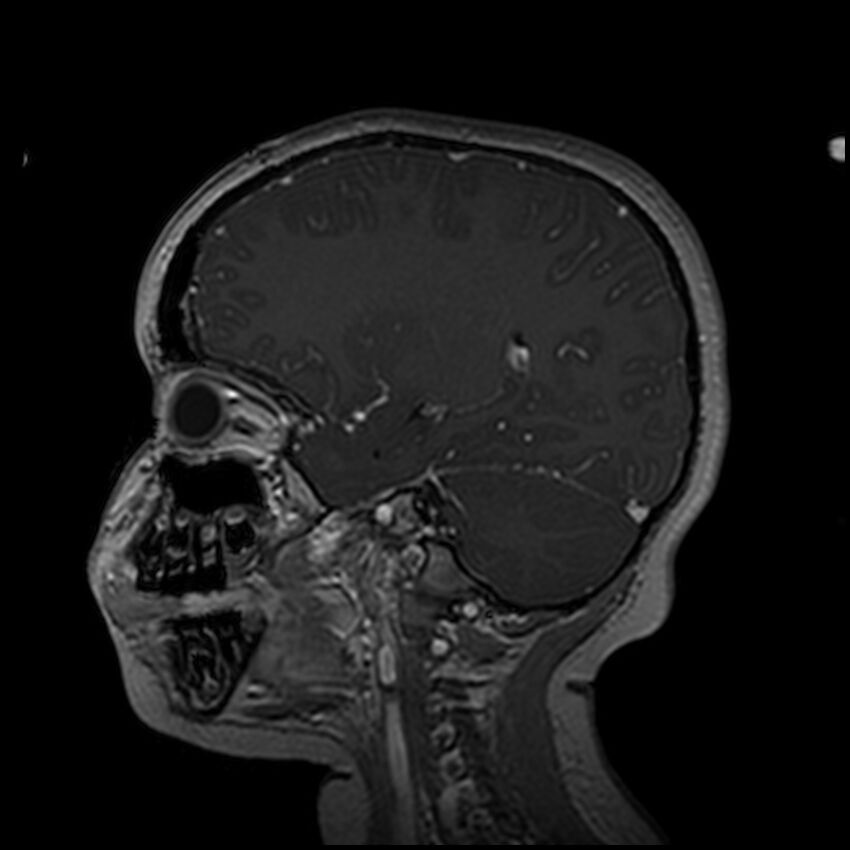 Adamantinomatous craniopharyngioma (Radiopaedia 77407-89529 H 79).jpg
