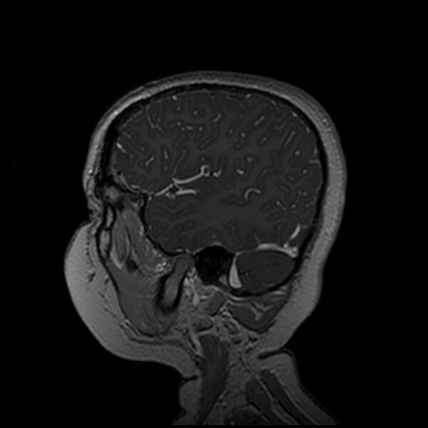 File:Adamantinomatous craniopharyngioma (Radiopaedia 77407-89529 H 97).jpg