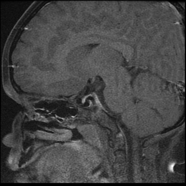 File:Adamantinomatous craniopharyngioma (Radiopaedia 77407-89529 Sagittal T1 C+ fat sat 5).jpg