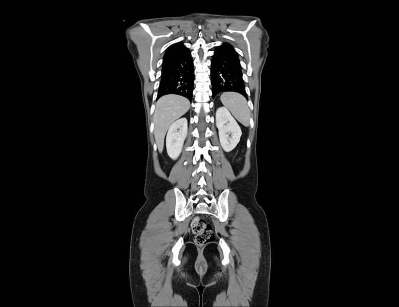 File:Addison disease (Radiopaedia 49318-54412 Coronal C+ portal venous phase 9).jpg