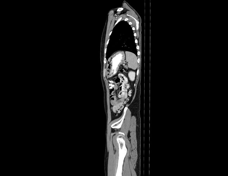 File:Addison disease (Radiopaedia 49318-54412 Sagittal C+ portal venous phase 12).jpg