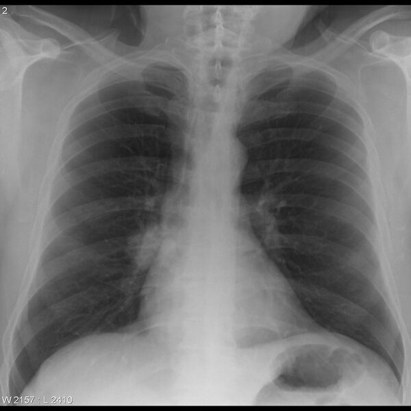 File:Adenocarcinoma of lung (Radiopaedia 24509-24798 Frontal 1).jpg