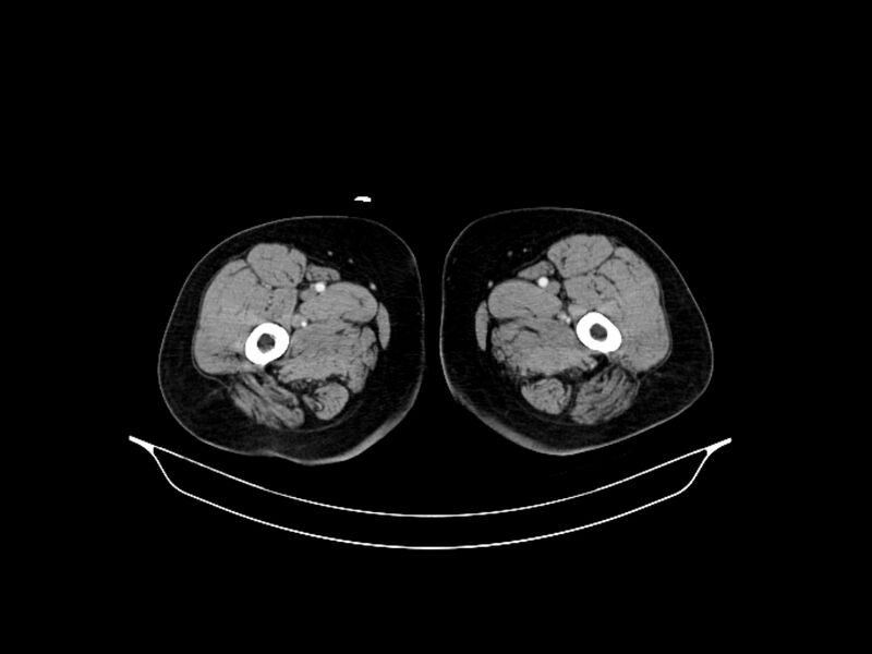 File:Adenocarcinoma of pancreas with hepatic metastasis (Radiopaedia 64332-73122 Axial C+ portal venous phase 120).jpg