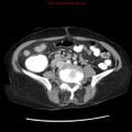 Adenocarcinoma of the colon (Radiopaedia 8191-9039 Axial liver window 46).jpg