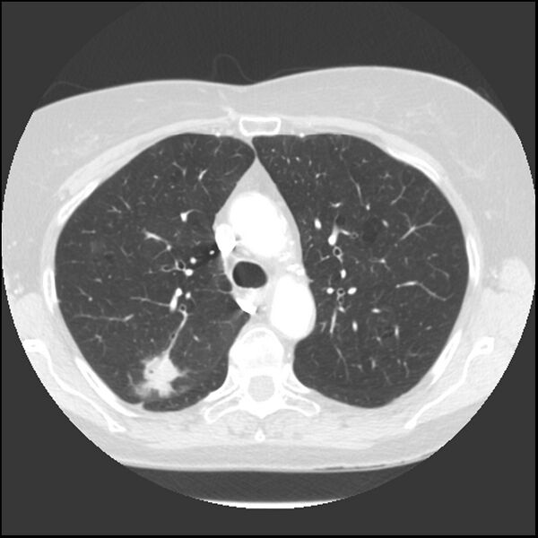 File:Adenocarcinoma of the lung (Radiopaedia 41015-43755 Axial lung window 39).jpg