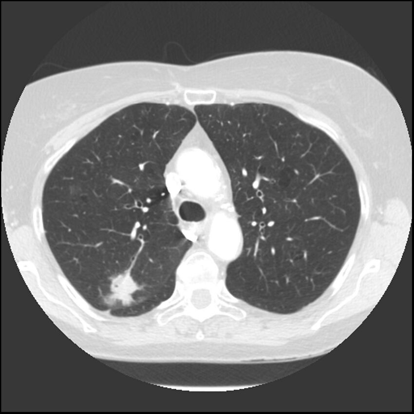 Adenocarcinoma of the lung (Radiopaedia 41015-43755 Axial lung window 39).jpg