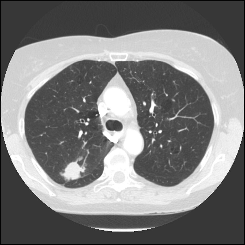 Adenocarcinoma of the lung (Radiopaedia 41015-43755 Axial lung window 40).jpg