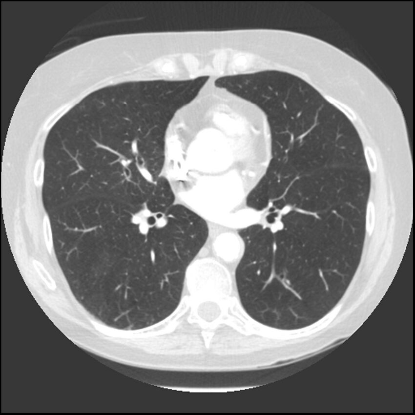 Adenocarcinoma of the lung (Radiopaedia 41015-43755 Axial lung window 70).jpg