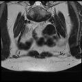 Adenoma malignum of the cervix (Radiopaedia 24460-24765 Coronal T2 1).jpg