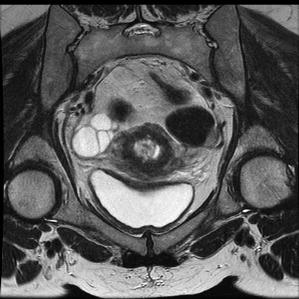 File:Adenoma malignum of the cervix (Radiopaedia 24460-24765 Coronal T2 13).jpg