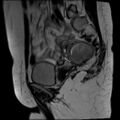 Adenomyosis and endometriotic cysts (Radiopaedia 82300-96367 Sagittal T2 23).jpg