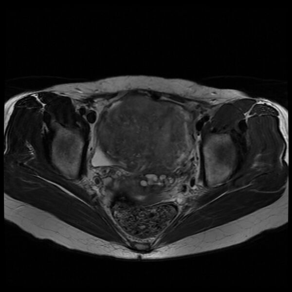 File:Adenomyosis on MRI (Radiopaedia 29328-29780 Axial T2 7).jpg