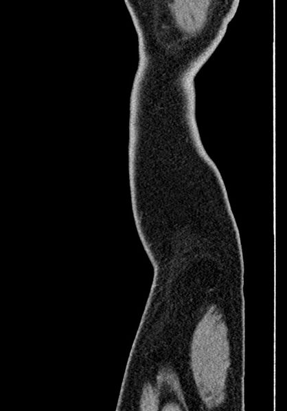File:Adhesional small bowel obstruction (Radiopaedia 58900-66131 Sagittal C+ portal venous phase 251).jpg