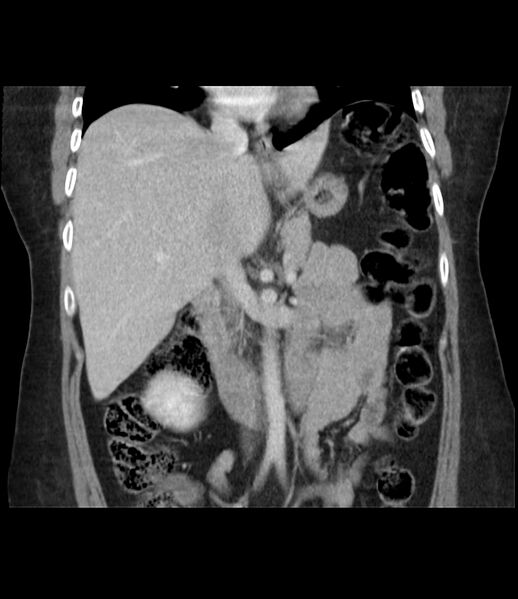 File:Adrenal cortical carcinoma with IVC invasion and thrombosis (Radiopaedia 34307-35597 Coronal C+ portal venous phase 26).jpg