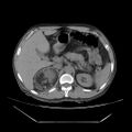 Adrenal myelolipoma (Radiopaedia 41843-44834 Axial non-contrast 21).jpg