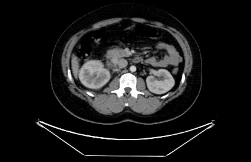 Adrenocortical carcinoma (Radiopaedia 80134-93438 Axial C+ portal venous phase 57).jpg