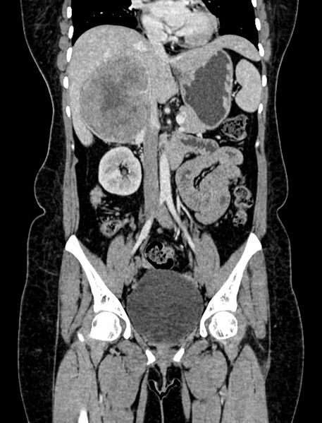 File:Adrenocortical carcinoma (Radiopaedia 87281-103569 Coronal C+ portal venous phase 39).jpg