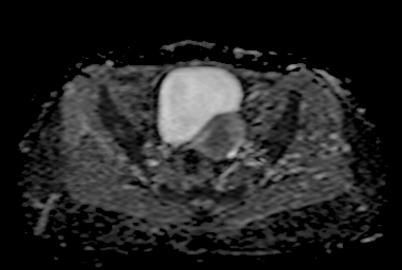 File:Adult granulosa cell tumor of the ovary (Radiopaedia 71581-81950 Axial ADC 14).jpg