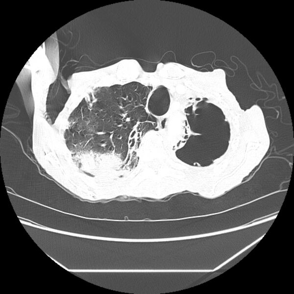 File:Advanced pulmonary tuberculosis (Radiopaedia 8599-9431 Axial lung window 10).jpg