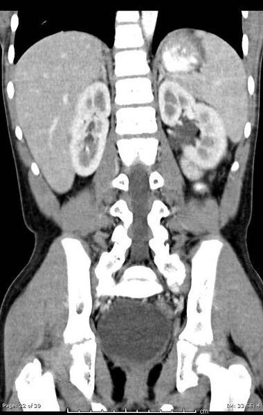 File:Agenesis of the gallbladder (Radiopaedia 55454-61905 A 32).jpg