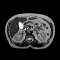 Ampullary tumor (Radiopaedia 27294-27479 T2 9).jpg